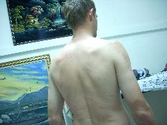 Bedbug bites